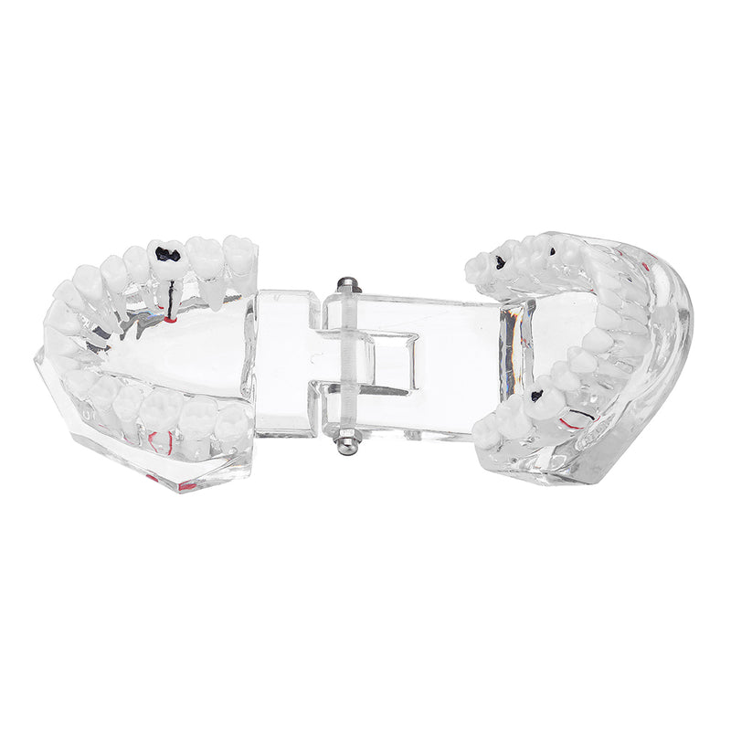 Clear Dental Teeth Study Teaching Model Crystal Typodont Model Removable Teeth Model Medical Model