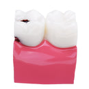 6X Human Dental Caries Teeth Tooth Decay Two-Side Comparison Model Pathology Patient Education Medical Model