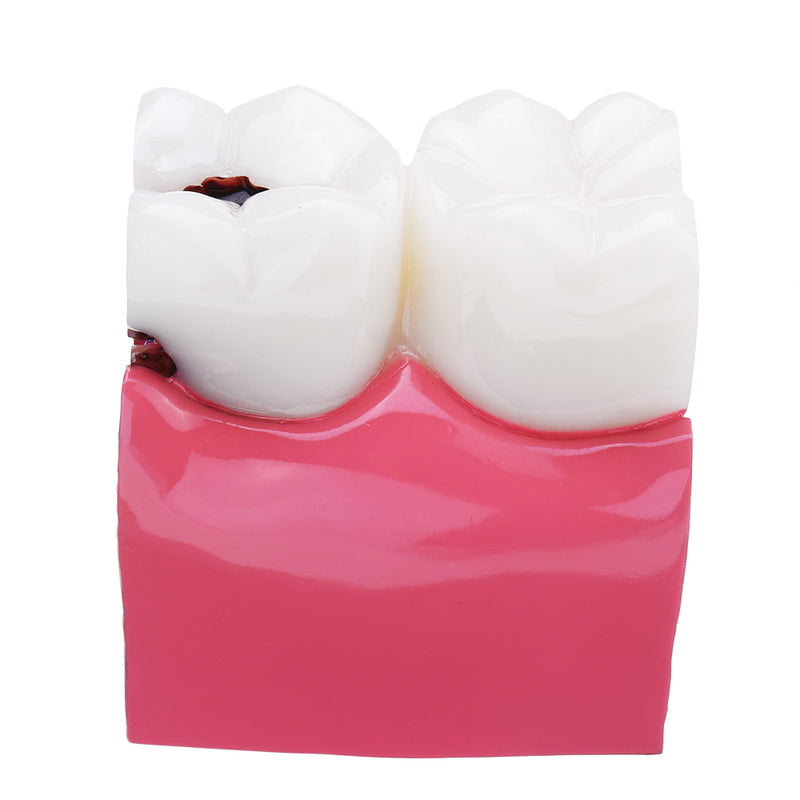 6X Human Dental Caries Teeth Tooth Decay Two-Side Comparison Model Pathology Patient Education Medical Model
