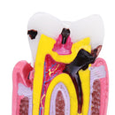 6X Human Dental Caries Teeth Tooth Decay Two-Side Comparison Model Pathology Patient Education Medical Model