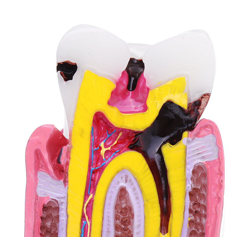 6X Human Dental Caries Teeth Tooth Decay Two-Side Comparison Model Pathology Patient Education Medical Model