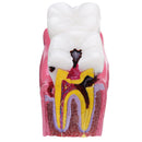6X Human Dental Caries Teeth Tooth Decay Two-Side Comparison Model Pathology Patient Education Medical Model