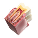 Caries Teeth Comparation Model Dental Study Education Demonstration