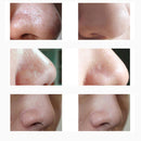 Electric Blackhead Suction Remover 3 Levels Facial Pore Vacuum Cleaner Acne Removal Device with 4 Head