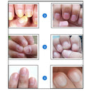 Nail Repair Cream & Essence Set Fingernail Care Treatment Onychomycosis Remover