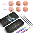 Lucky Fine Blackhead Acne Remover Tool Kit Stainless Steel Skin Care Tools Set