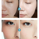Hyaluronic Acid Serum Moisturizing Essence Face Cream Acne Treatment Skin Care