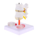 Lab Supplies 1:1 Human Spine Lumbar Vertebra with Diseased Intervertebral Disc Model School Teaching Display