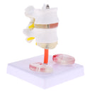 Lab Supplies 1:1 Human Spine Lumbar Vertebra with Diseased Intervertebral Disc Model School Teaching Display