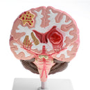 Minification 1X Human Brain Brainstem Cerebral Hemorrhage Diseased Pathological Model Teaching Model