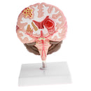 Minification 1X Human Brain Brainstem Cerebral Hemorrhage Diseased Pathological Model Teaching Model