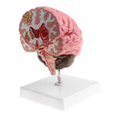 Minification 1X Human Brain Brainstem Cerebral Hemorrhage Diseased Pathological Model Teaching Model