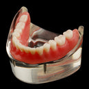 Oral Teeth Study Teach Demonstration Model Overdenture Inferior 2 Implant Demo Teaching Model - Clear Base