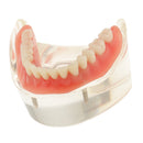 Oral Teeth Study Teach Demonstration Model Overdenture Inferior 2 Implant Demo Teaching Model - Clear Base