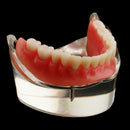 Oral Teeth Study Teach Demonstration Model Overdenture Inferior 2 Implant Demo Teaching Model - Clear Base