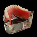 Oral Teeth Study Teach Demonstration Model Overdenture Inferior 2 Implant Demo Teaching Model - Clear Base