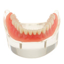 Oral Teeth Study Teach Demonstration Model Overdenture Inferior 2 Implant Demo Teaching Model - Clear Base