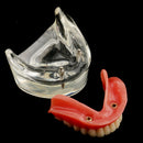 Oral Teeth Study Teach Demonstration Model Overdenture Inferior 2 Implant Demo Teaching Model - Clear Base