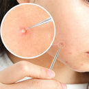 4Pcs Facial Pimple Acne Spot Pimple Remover Blackhead Whitehead Extractor Needles Tool Case Anti-Allergic Stainless Steel