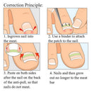 Ingrown Toenail Correction Patch Kit, Professional Toe Nail Care Pedicure Manicure Sticker Fixer Corrector Tool, Paronychia Toenail Pain Relief