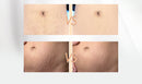 Rosalind Dilute Scar Acne Scars Stretch Marks To Stretch Marks Cream