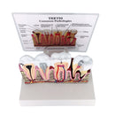Tooth Pathology Dissection Model Decayed Tooth Gingival Dissection 6.5Ã—5Ã—4 inch High Quality