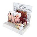 Tooth Pathology Dissection Model Decayed Tooth Gingival Dissection 6.5Ã—5Ã—4 inch High Quality
