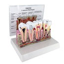 Tooth Pathology Dissection Model Decayed Tooth Gingival Dissection 6.5Ã—5Ã—4 inch High Quality