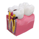 6X Human Dental Caries Teeth Tooth Decay Two-Side Comparison Model Pathology Patient Education Medical Model