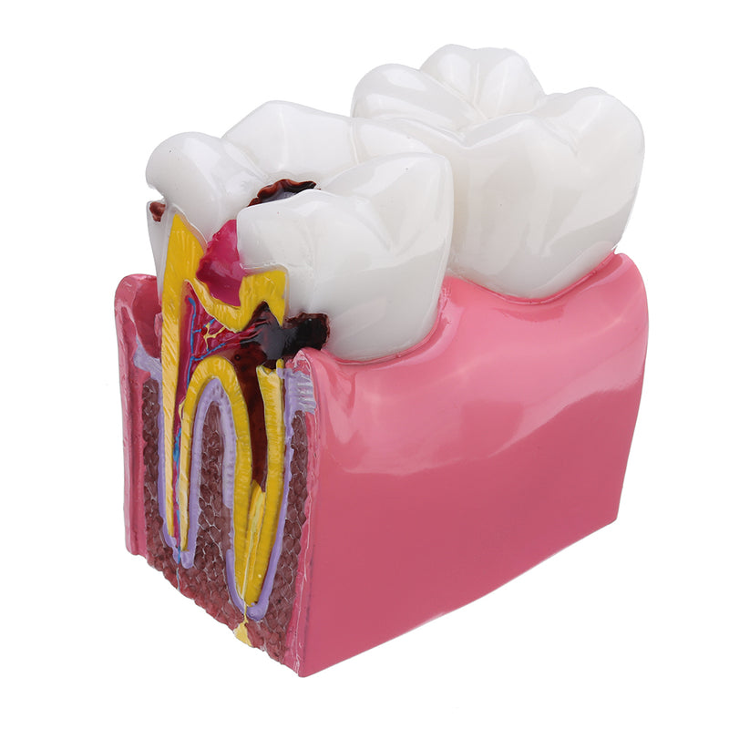 6X Human Dental Caries Teeth Tooth Decay Two-Side Comparison Model Pathology Patient Education Medical Model