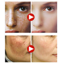 12 DAYS EFFECT! KMELE Day & Night Scar Removal Cream Face Anti Freckle Brighten Whitening US