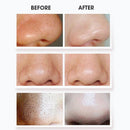 Electric Blackhead Suction Vacuum Acne Remover Pore Dermabrasion Cleaner Blackhead Remover Vacuum Pore Cleaner Acne Comedone Extractor Tool