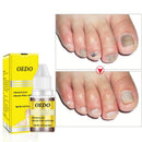 OEDM Nail Treatment Onychomycosis Paronychia Anti Fungal Nail Infection Toe Nail Fungus Treatment