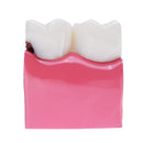 6X Human Dental Caries Teeth Tooth Decay Two-Side Comparison Model Pathology Patient Education Medical Model