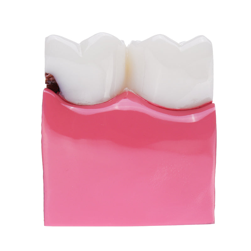 6X Human Dental Caries Teeth Tooth Decay Two-Side Comparison Model Pathology Patient Education Medical Model