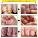 OEDM Nail Treatment Onychomycosis Paronychia Anti Fungal Nail Infection Toe Nail Fungus Treatment