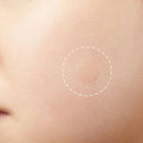 3 PCS Acne Tool Set Treatment Acne Scar Pimples Sticker