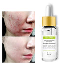 Tea Tree Remove Acne Essence Shrink Pores Repair Acne Marks Blackheads Essence Face Care 15ml Shrink Pores Repair Acne Marks Blackheads Essence Face Care 15ml
