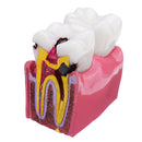 6X Human Dental Caries Teeth Tooth Decay Two-Side Comparison Model Pathology Patient Education Medical Model