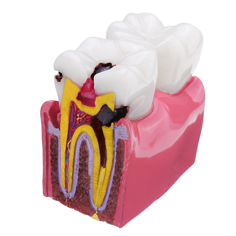 6X Human Dental Caries Teeth Tooth Decay Two-Side Comparison Model Pathology Patient Education Medical Model