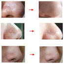 Electric Facial Vacuum Blackhead Acne Remover Electric Blackhead Suction Nose Pore Deep Cleanser Tools Lifting Firming Skin