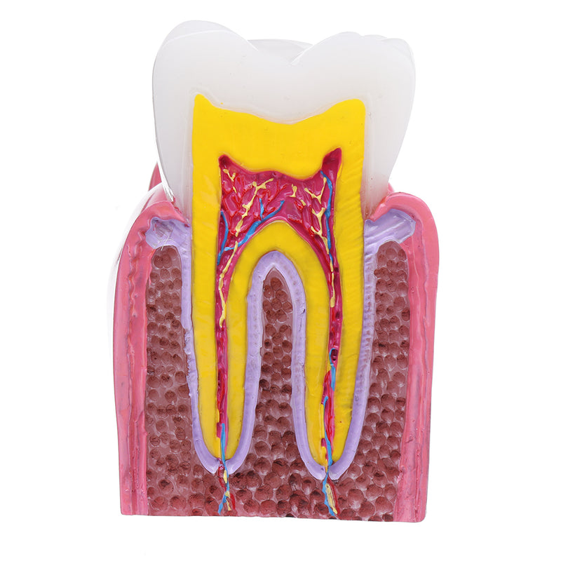 6X Human Dental Caries Teeth Tooth Decay Two-Side Comparison Model Pathology Patient Education Medical Model