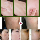 Suction Spot Cream Face Care Whitening Remove Freckle Dark Spots Scar Whitening Cream
