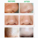 Electric Blackhead Vacuum Blackhead Acne Remover Face Pore Dermabrasion Cleaner Suction Electric Blackhead Suction