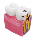 6X Human Dental Caries Teeth Tooth Decay Two-Side Comparison Model Pathology Patient Education Medical Model