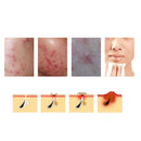 35ml Aloe Acne Scar Removal Cream Gel Skin Care Repair Comedo Pimple Face Gel
