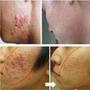 30g Acne Scar Removal Cream Skin Repair Cream Cream