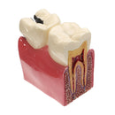 Caries Teeth Comparation Model Dental Study Education Demonstration