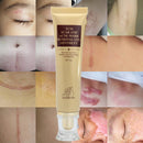30g Acne Scar Removal Cream Skin Repair Cream Cream