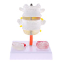 Lab Supplies 1:1 Human Spine Lumbar Vertebra with Diseased Intervertebral Disc Model School Teaching Display